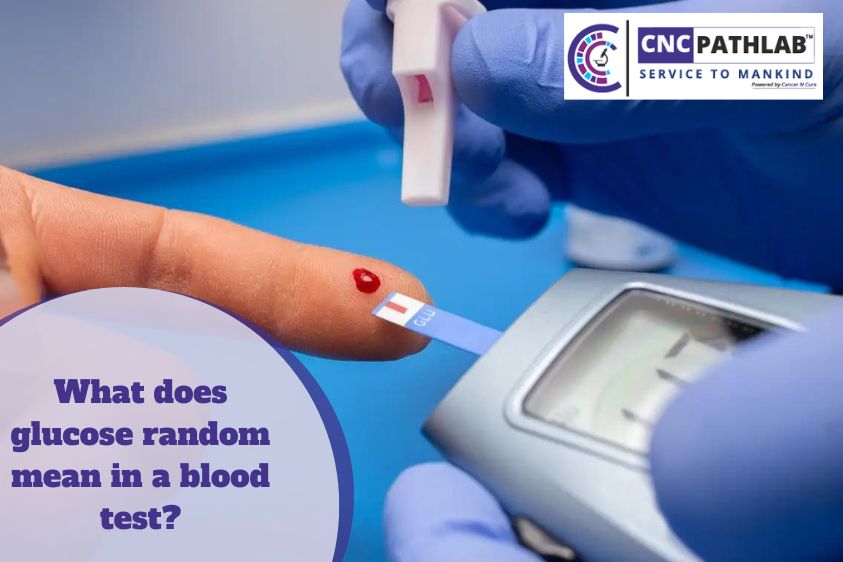 What Does Glucose Random Mean In A Blood Test?